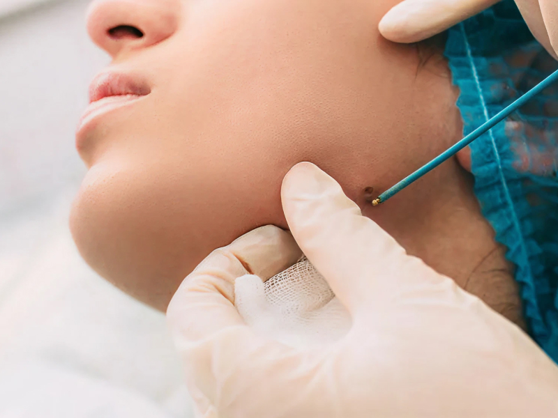 Видалення новоутворень