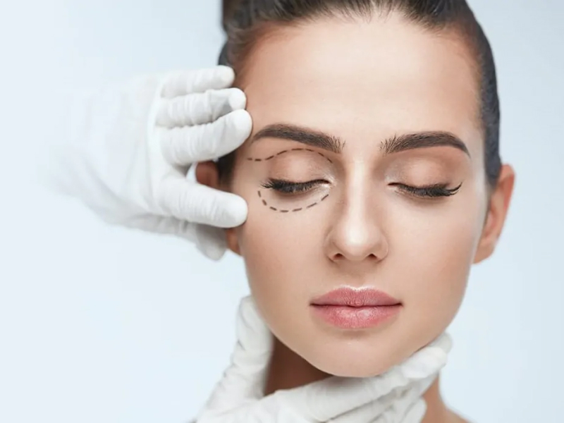 Блефаропластика