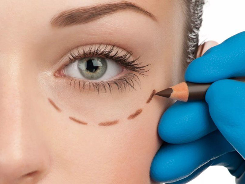 Зморшки навколо очей