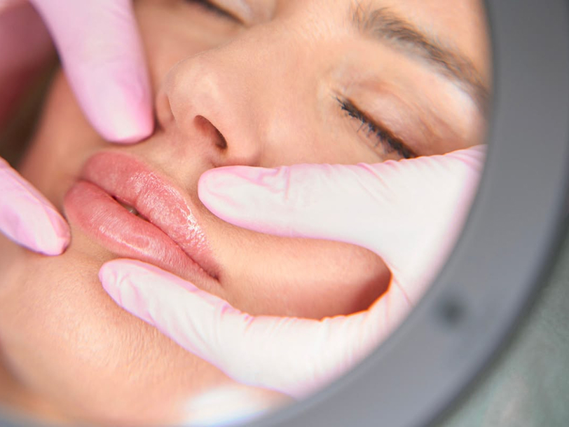 Лазерне збільшення губ без філерів Fotona Smooth Lips