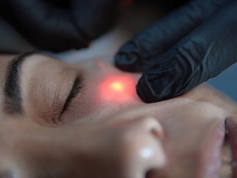 Омолодження повік Fotona Smooth Eye