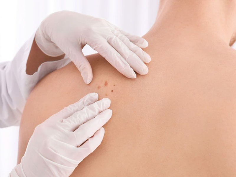 Видалення пігментацій