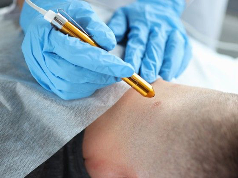 Видалення родимок, невусів