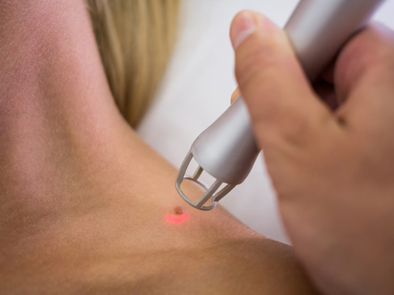 Видалення папілом, кондилом