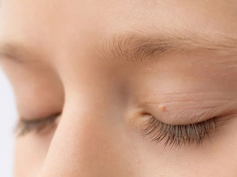 Видалення в зоні повік