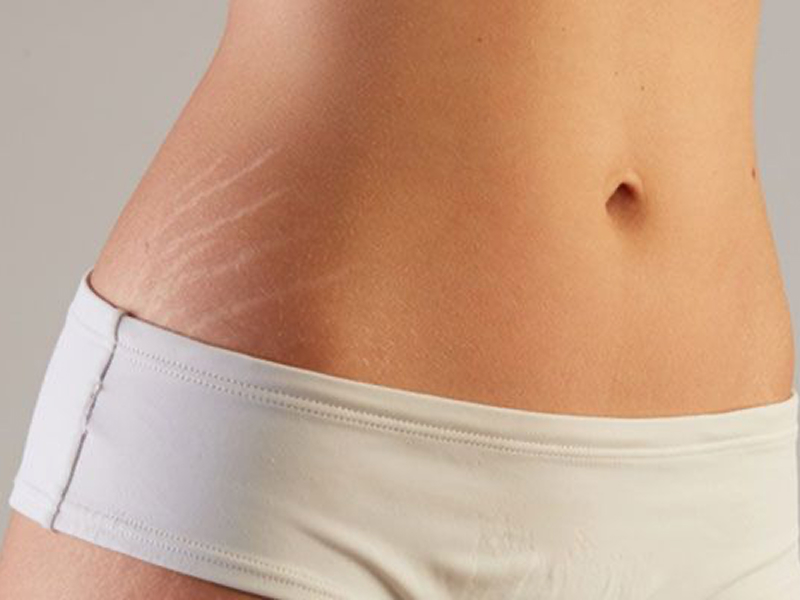 Лазерне лікування розтяжок