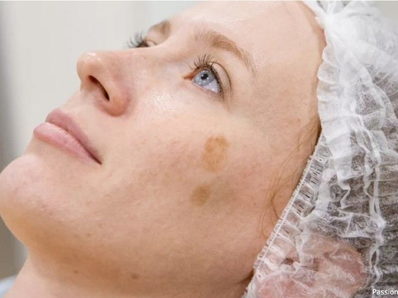 Лазерне лікування пігментацій