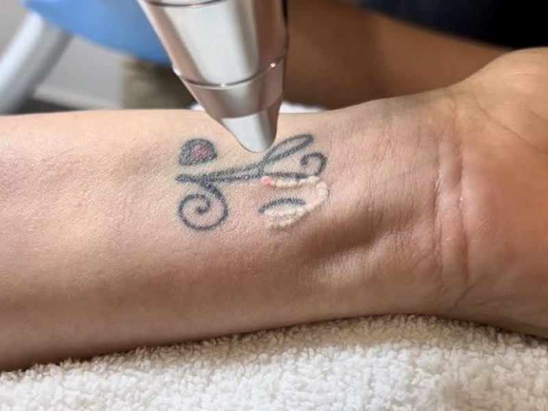 Лазерне видалення тату та татуювань