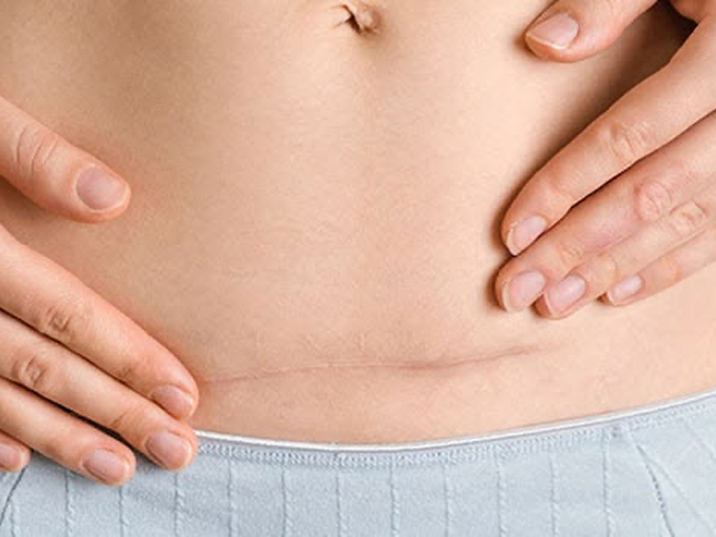 Лазерне лікування рубців, шрамів