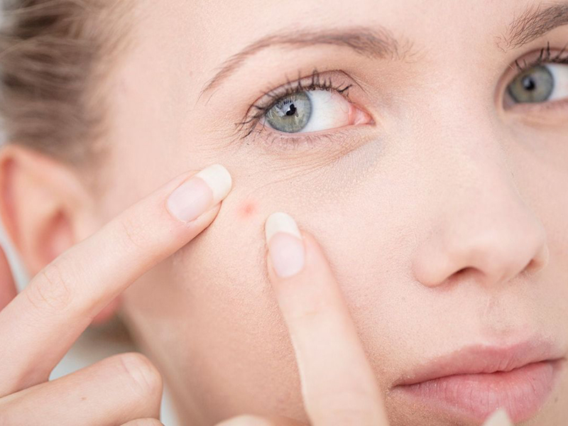 Лазеротерапія вугрової хвороби