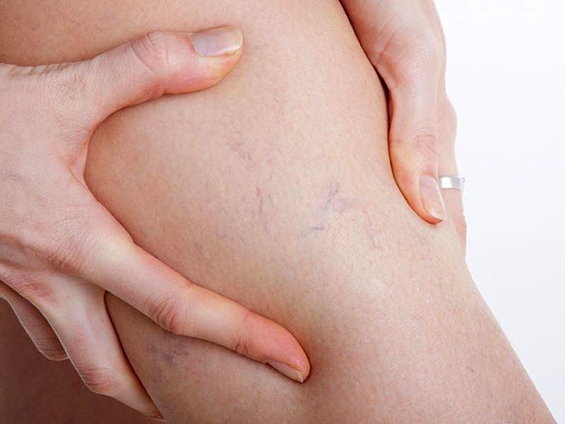 Видалення судин на кінцівках та тілі