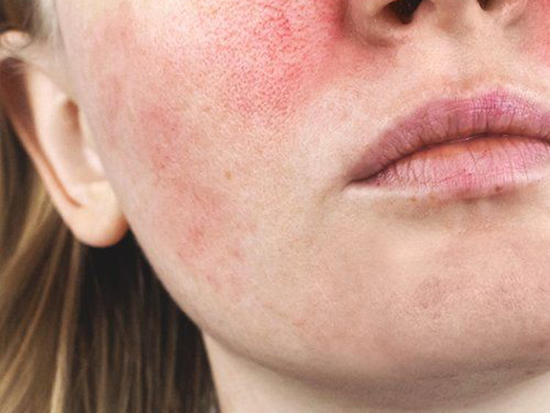 Лазерне лікування куперозу, розацеа 